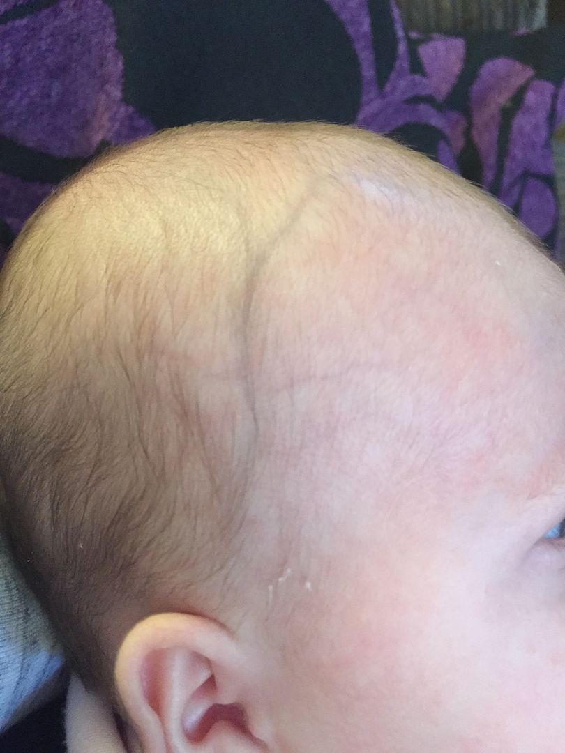 Veins On Babys Head Babycentre